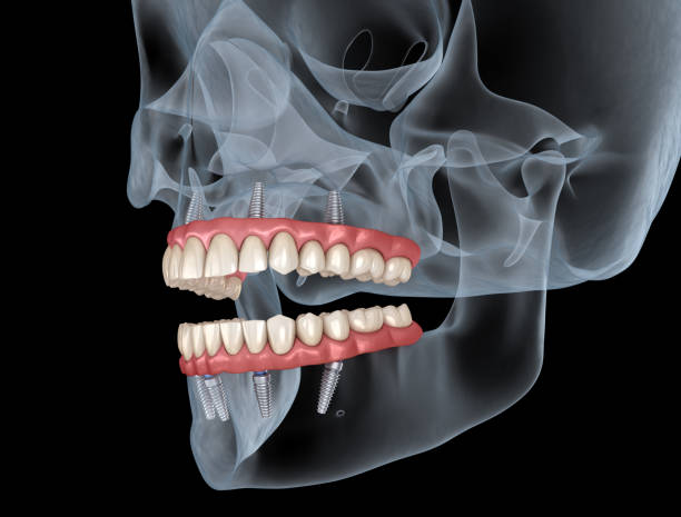 Poseban fokus: ugradnja dentalnih implantata i All-on-X rješenja